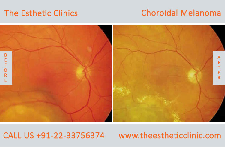 Choroidal Melanoma Eye Cancer Treatment before after photos in mumbai india (1)